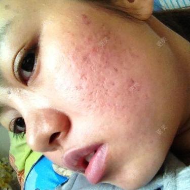 脸上起痘痘留疤怎么办