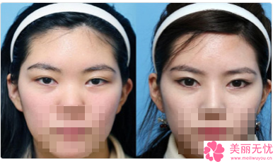 南充隆鼻美容