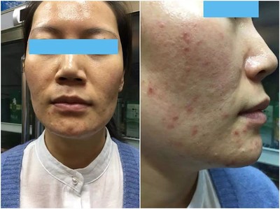 长痘痘变好的帖子