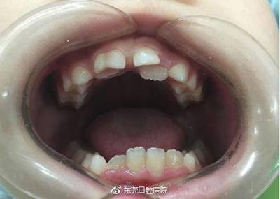 小孩怎么拔牙