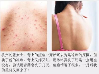 男人背上长痘痘用什么洗