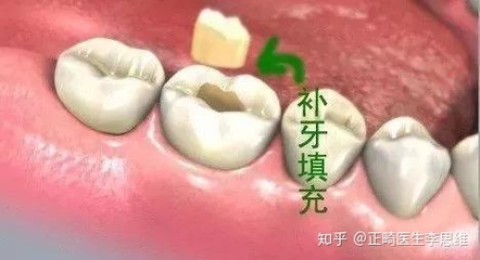 补牙齿材料