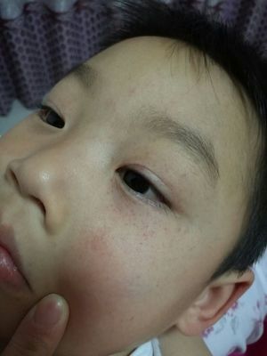 眼睛周围红是怎么回事