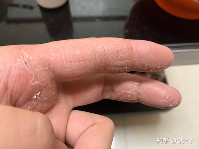 手指上起皮是怎么回事