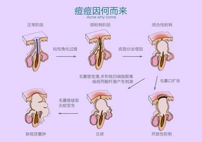 广州治疗痘痘点击美莱