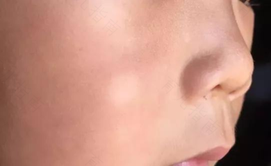 宝宝脸上有虫斑怎么办