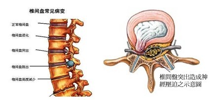 椎间盘膨突出怎么治疗