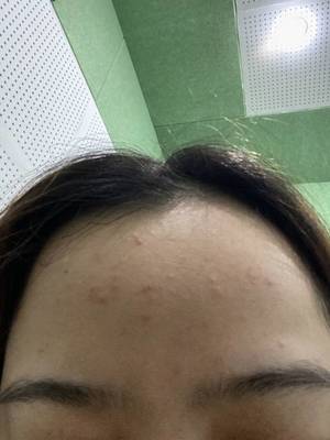 怎么除额头上痘痘