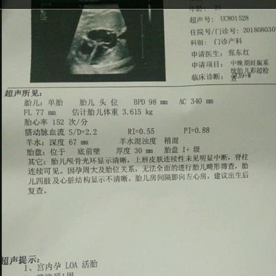 胎儿在左边
