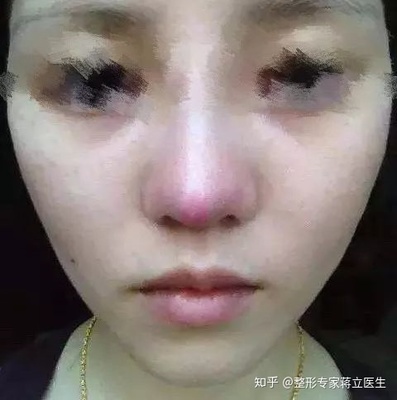 隆鼻后长了颗痘痘