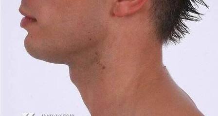 男人没有喉结是怎么回事