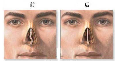 鼻中隔偏曲怎么治疗
