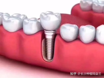 种牙好还是镶牙好