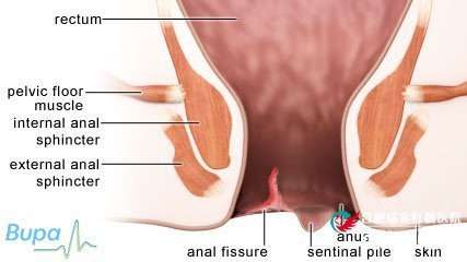 怎么治疗肛裂