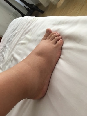脚面浮肿是怎么回事