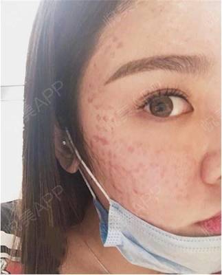 水光针的作用与功效