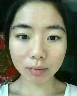 两个星期痘痘好不了