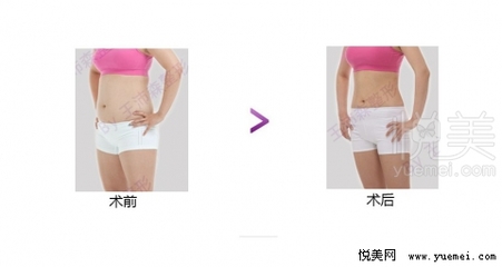 肚子抽脂安全吗