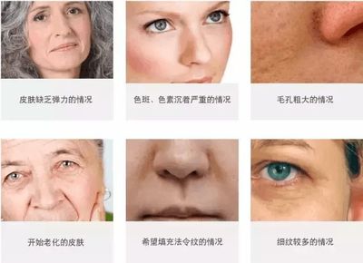 脸上有痘痘能打水光针吗