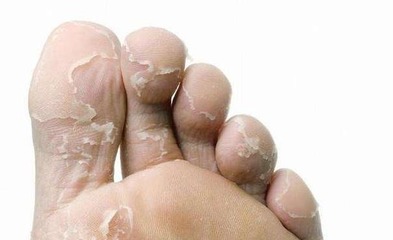 手脚潮湿是怎么回事