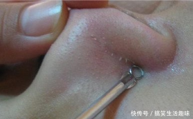 毛孔有白色条状物