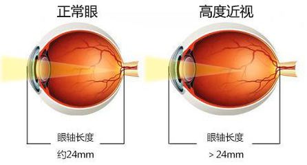 弱视是怎么回事