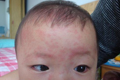 幼儿急疹后咳嗽