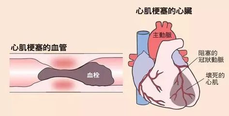 心机缺血是怎么回事