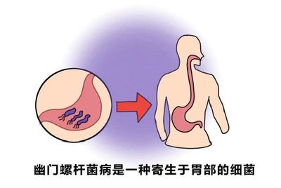 宝宝感染幽门螺旋杆菌