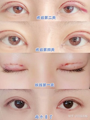 双眼皮抽线怎么抽