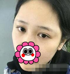 割了双眼皮能看手机吗