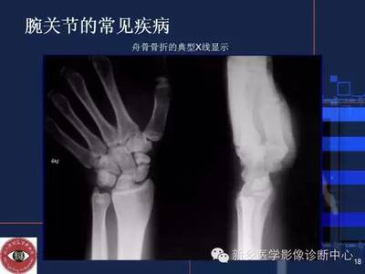 右手舟骨骨折能评几级伤残