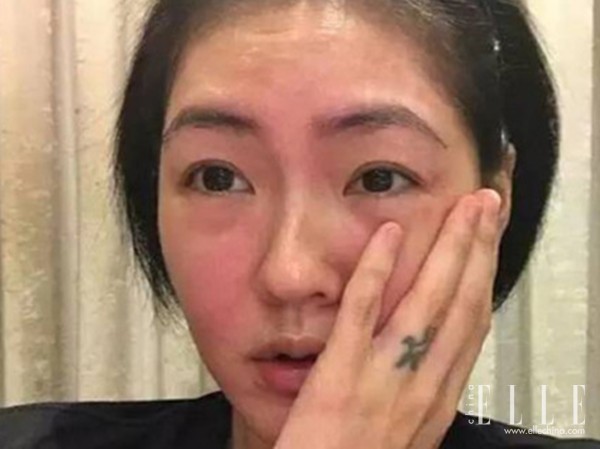 过敏脸肿了是怎么回事