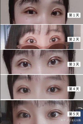 做双眼皮大概费用