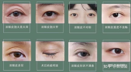 双眼皮割的太窄了