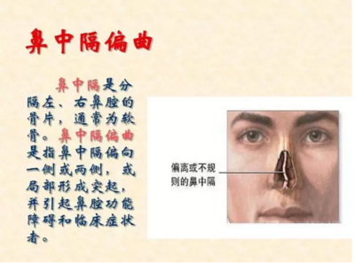 鼻中隔偏曲怎么治疗