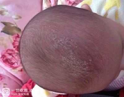 新生儿乳痂图片