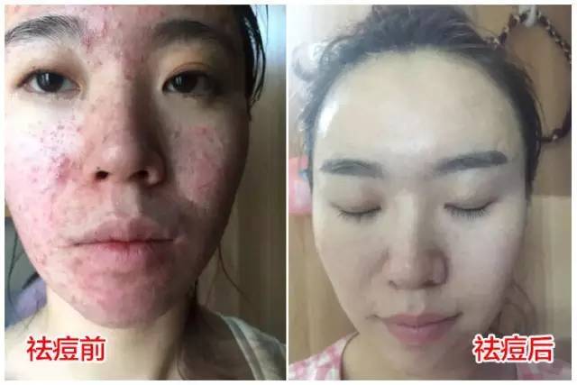 30岁痘痘一脸