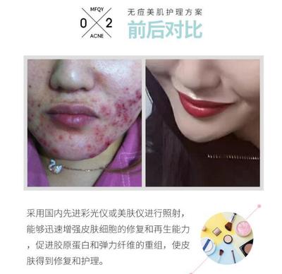怎么快速消炎祛痘