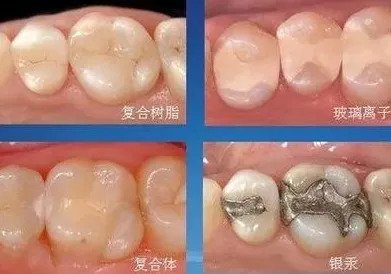 洗牙后多久可以补牙