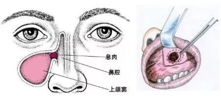 上颌窦囊肿怎么治疗