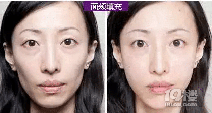 玻尿酸填充面颊