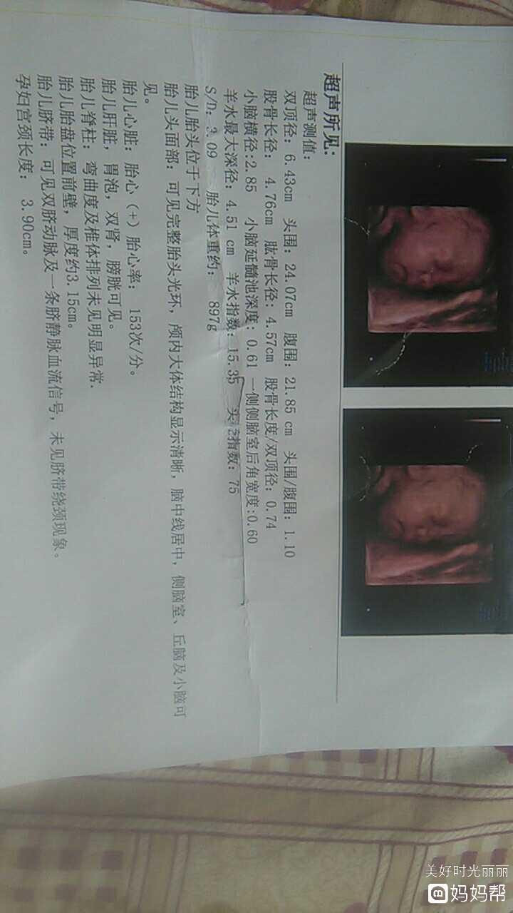 孕妇宫颈长度