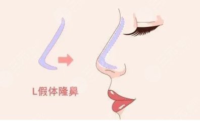 假体隆鼻恢复过程