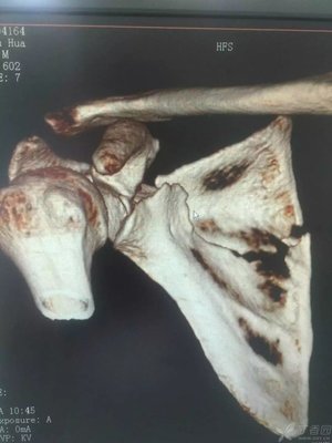 肩胛骨骨折怎么治疗