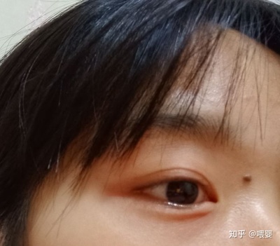 眼睛疼又肿是怎么回事