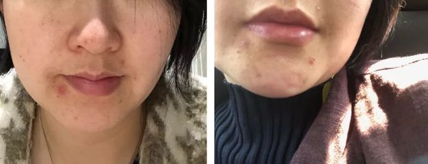 痘痘爆不出来吗
