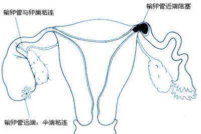 输卵管伞端粘连应该怎么治疗