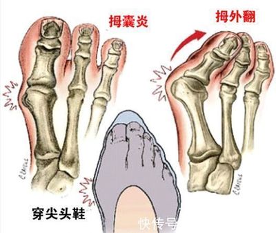 拇外翻是怎么回事