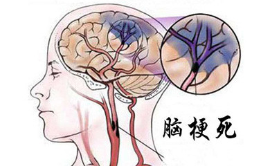 脑梗是怎么回事